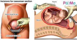 Lazimnya, prosedur ia membabitkan pembedahan besar. Tak Tahan Sakit Nak Bersalin Minta Doktor Operate Ibu Hamil Dan Suami Perlu Tahu Risiko Yang Bakal Mereka Hadapi Pa Ma