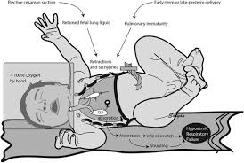 Image result for Delayed Transition from Fetal Circulation