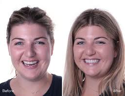 Before & After Gallery