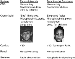 Comparison Of Birth Defects In Fanconi Anemia 28 And Fetal Alcohol Download Scientific Diagram