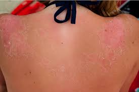 2nd degree sunburns swelling after sunburn how long does sunburn last sunburn turned into dark tan if my sunburn is healing, why did i get bubbles after i showered this morning? Sunburn Peeling Prevention And How To Stop It Once It Starts