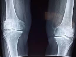 Rank the case scenarios on probability of developing persistent erosive ra. Osteoarthritis Vs Rheumatoid Arthritis Drgreenknight