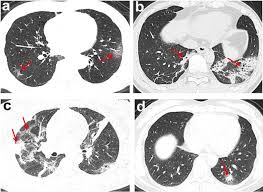 Ct Imaging Changes Of Corona Virus Disease 2019 Covid 19 A Multi Center Study In Southwest China Journal Of Translational Medicine Full Text