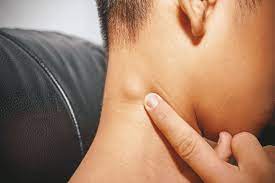 Obat kelenjar, obat kelenjar getah bening. Kenali Gejala Penyebab Dan Cara Mencegah Kanker Kelenjar Getah Bening