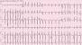 Accelerated Junctional Escape