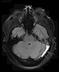 Based on the affected venous structures, the following subtypes of cvst can be distinguished: Cureus Cerebral Sinus Venous Thrombosis In The Setting Of Acute Mastoiditis