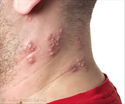 En español | the side effects of the shingles virus can range from extremely unpleasant to nightmarish, especially when the virus affects the eye. Shingles Patients At An Increased Risk Of Heart Attack Stroke