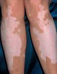 Astept parerea si sfatul dumneavoastra! Pete Albe Pe Corp Ce Este Cauze Posibile Èi Metode De Tratament