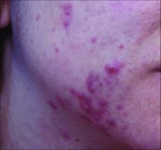 Check spelling or type a new query. Grade Iv Severe Acne Showing Many Large Inflamed Nodules And Pustules Download Scientific Diagram
