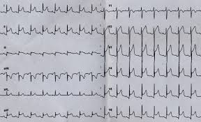 Acest tip de bloc determină la nivelul nav blocul av de tip ii, care este de două tipuri. Http Web2 Sacrocuore It Oncologia Negrar 25 26 Gennaio 2019 Sinagra Pdf