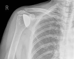 Image result for Shoulder XRay