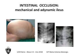 Image result for Adynamic Ileus