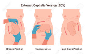 Image result for External Cephalic Version