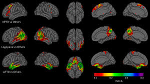 Get answers to these questions and more in this nia fact sheet. The Semantic Storage Loss Score An Algorithm For Measuring An Individual S Level Of Semantic Storage Loss Due To Temporal Lobe Damage In Neurodegenerative Disease