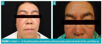 Jun 03, 2021 · la panne orange qui a touché l'ensemble de l'hexagone durant quelques heures mercredi 2 juin dans la soirée a eu des conséquences dramatiques. Effective Treatment Of Morbihan S Disease With Long Term Isotretinoin A Report Of Three Cases Jcad The Journal Of Clinical And Aesthetic Dermatology