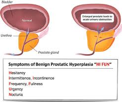 Rosh Review Nursing Mnemonics Benign Prostatic Hyperplasia Nursing School Notes