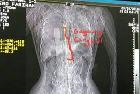 We did not find results for: Ini Hasil Rontgen Gagang Cangkul Di Tubuh Eno Korban Pembunuhan Sadis