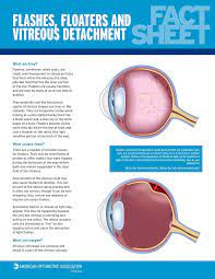 2 Sided Fact Sheet About Flashes Floaters And Vitreous Detachment Order Yours Today Eye Health Eye Care Diseases Of The Eye
