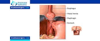 A patient's health affects the time it takes to recover from hernia mesh surgery. Hiatal Hernia Recovery Time Hiatal Hernia Surgery Recovery Time