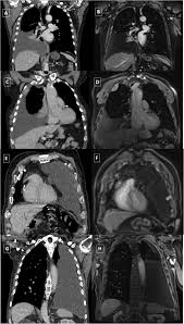 Feasibility and logistics of setting up a quantitative imaging study. A Comparison Between Mri And Ct In The Assessment Of Primary Tumour Volume In Mesothelioma Lung Cancer