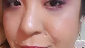 Stories of NF: Cassey B.