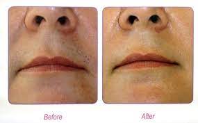 As such, prices can vary based on treatment areas as well as hair types and skin sensitivity. Laser Hair Removal Prices At Canova Medical In Wilmslow