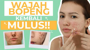 Cara menghilangkan jerawat dengan cepat menggunakan bahan alami yang pertama adalah menggunakan bawang putih. Jangan Panik Ini 6 Cara Menghilangkan Jerawat Batu Di Wajah Youtube