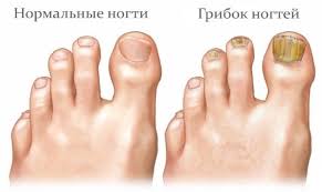 что делать с вросшим ногтем на большом пальце ноги Vrosshij Nogot Na Bolshom Palce Nogi Lechenie Lazerom Mazyami V Domashnih Usloviyah Bez Operacii Esli Zagnoilsya Krasnye Narosty Vokrug Foto