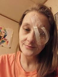 A young woman recently took to social media to document her journey  undergoing fox eye surgery, a controversial cosmetic procedure designed to  lift and elongate the eyes. Sharing every step—from consultations to