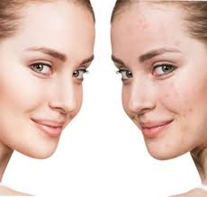 Combat pimples and prevent against acne