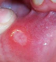 Image result for Mouth ulcers roof of mouth