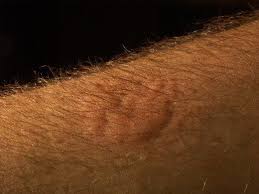 Sometimes Bed Bug Bites Look Like Welts Bed Bug Bites Pictures Bed Bugs Bed Bug Bites