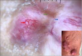 Image result for Dermatofibrosarcoma Protuberans