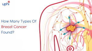 There are various types of breast cancer, and they are. How Many Types Of Breast Cancer Found