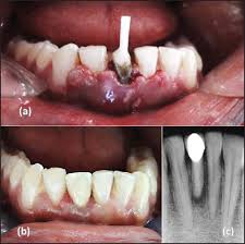 A post and core crown is a type of dental restoration required where there is an inadequate amount of sound tooth tissue remaining to retain a conventional crown. A Placement Of A Prefabricated Glass Fiber Post Immed Open I