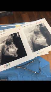 Orthognathic (corrective jaw) surgery in provo ut: Jaw Surgery Faq Kimbermoose