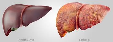 Tahukah anda, penyakit kanser hati mempunyai simptom dan tanda yang tersendiri? Tanda Tanda Kanser Hati Yang Ramai Tak Tahu