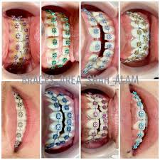 Di sini, pengunjung dibenarkan memilih bahagian ayam yang ingin dimakan. Braces Area Shah Alam Home Facebook