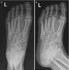 The third metatarsal bone is a long bone in the foot. Metatarsus Springerlink