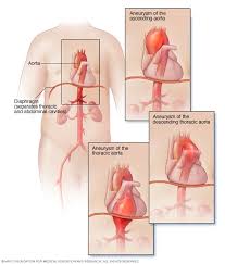 Thoracic Aortic Aneurysm Symptoms And Causes Mayo Clinic By contrast, false aneurysms are external hematomas with a persistent communication to a leaking artery.