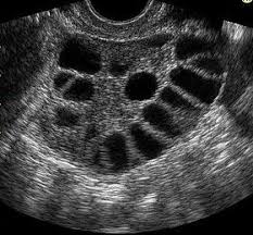 As discussed in part 2, polycystic ovary syndrome (pcos) can cause a wide range of symptoms,1 including: Pcos Los Angeles Tarzana