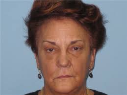 Dermal Fillers Before and After Photos by Paul Vanek, MD, FACS; Concord, OH 