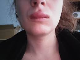 The problem with an ingrown hair on lip nobody likes to have an ingrown hair on the lip because it is remarkably similar to a cold sore or oral herpes simplex virus. Ingrown Hair Removed And Became Infected Swollen Lip Ensued Medical