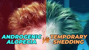 For the same, you can consult a urologist and get your serum testosterone levels checked. How To Test If You Have Male Pattern Baldness Or Telogen Effluvium