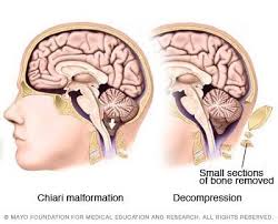 Chiari Malformation Symptoms And Causes Mayo Clinic Chiari Chiarimalformation Csf Brain Neurolo Chiari Malformation Chiari Chiari Malformation Surgery