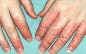 Dermatitis De Contacto Clinica Silva