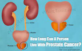 How Long Can A Person Live With Prostate Cancer