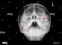Image result for Sinus X Ray
