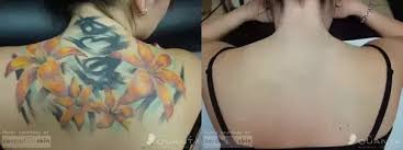 After getting a tattoo, it's normal to see some redness and swelling. Can Tattoos Be Removed And Will I Look Normal Again Quora