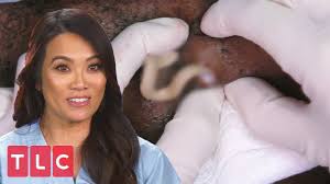 She is busy bringing up her little brother, marc, and has an intense relationship with her father, christian. Dr Lee Extracts Painful Cysts Dr Pimple Popper Youtube